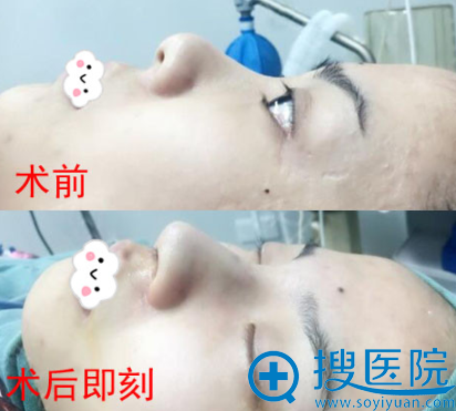 无锡米兰王忠志鼻综合隆鼻术前术后真实效果对比图 无锡米兰王忠志鼻综合隆鼻术前术后真实效果对比图