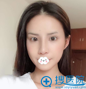 无锡米兰王忠志假体综合隆鼻7天效果 无锡米兰王忠志假体综合隆鼻7天效果
