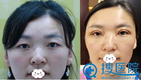 无锡米兰王忠志双眼皮+开眼角真人案例 无锡米兰王忠志双眼皮+开眼角真人案例