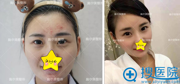 脸上如何祛痘?南京施尔美微针美塑祛痘详细过程及效果公开