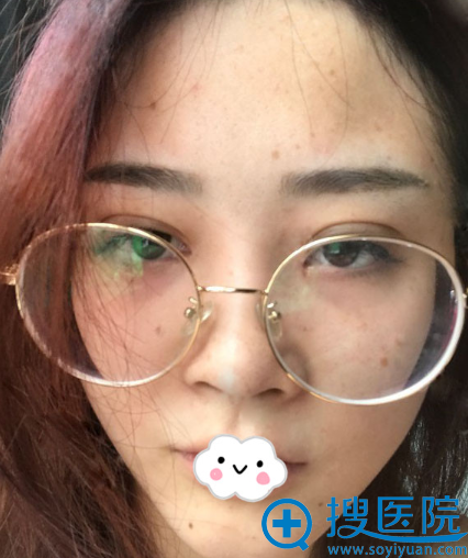 福州去斑哪家好?福州海峡整形医院皮秒激光祛斑术后案例效果图