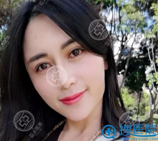 <!--<i data=20240710 data-id=12286></i>-->李瑞萱双眼皮案例30天效果 <!--<i data=20240710 data-id=12286></i>-->李瑞萱双眼皮案例30天效果