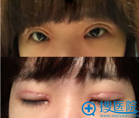 <!--<i data=20240710 data-id=11225></i>-->双眼皮术后真人案例 <!--<i data=20240710 data-id=11225></i>-->双眼皮术后真人案例
