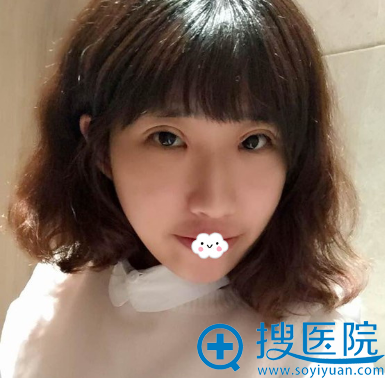 <!--<i data=20240710 data-id=11225></i>-->双眼皮术后效果图 <!--<i data=20240710 data-id=11225></i>-->双眼皮术后效果图