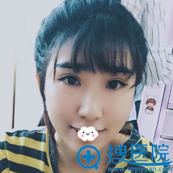 <!--<i data=20240710 data-id=11225></i>-->割双眼皮效果怎么样? <!--<i data=20240710 data-id=11225></i>-->割双眼皮效果怎么样?