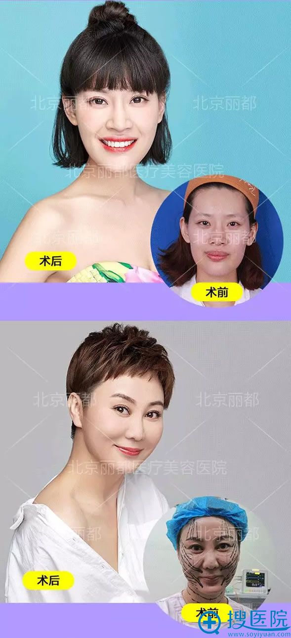 北京丽都整形线雕真人案例效果 北京丽都整形线雕真人案例效果