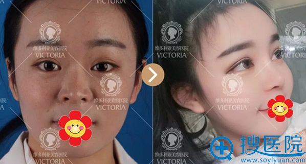 南京维多利亚李志生鼻综合隆鼻效果案例 南京维多利亚李志生鼻综合隆鼻效果案例