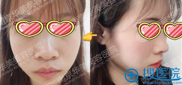 南京华美曹海峰隆鼻效果对比图 南京华美曹海峰隆鼻效果对比图