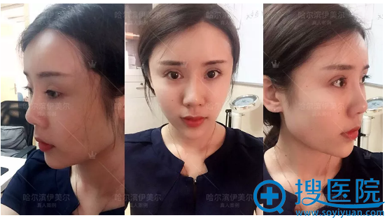 去哈尔滨伊美尔找王新东做完隆鼻后拿到一份2018整形价格表