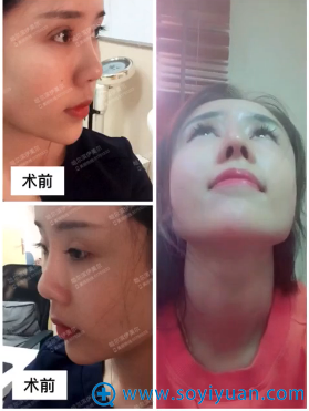 <!--<i data=20240710 data-id=12669></i>-->王新东隆鼻案例前后对比图 <!--<i data=20240710 data-id=12669></i>-->王新东隆鼻案例前后对比图