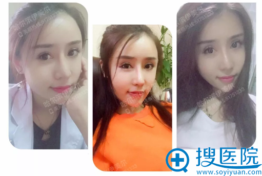 在<!--<i data=20240710 data-id=12669></i>-->做完综合鼻修复术后生活照 在<!--<i data=20240710 data-id=12669></i>-->做完综合鼻修复术后生活照