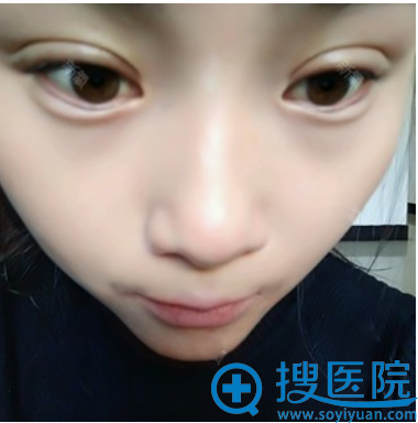 �п�˫��Ƥ��������15��ָ�Ч��ͼ