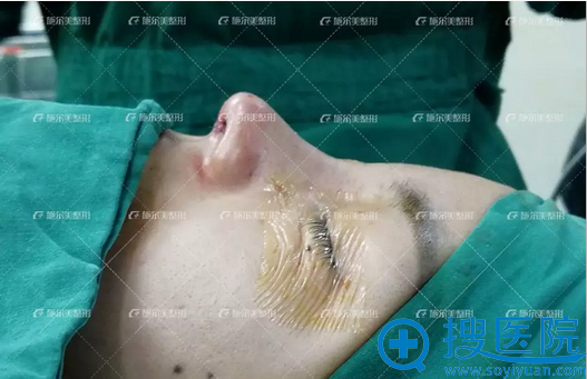 达拉斯综合隆鼻术后即刻 达拉斯综合隆鼻术后即刻