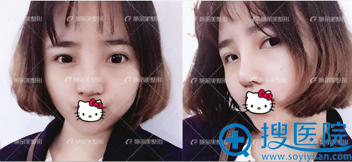 南京施尔美达拉斯鼻综合拆线后效果 南京施尔美达拉斯鼻综合拆线后效果