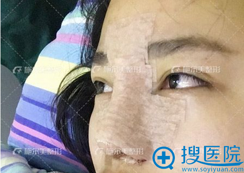 李彤彤鼻综合术后一天 李彤彤鼻综合术后一天