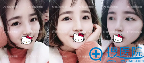 李彤彤达拉斯综合隆鼻术后恢复照片 李彤彤达拉斯综合隆鼻术后恢复照片