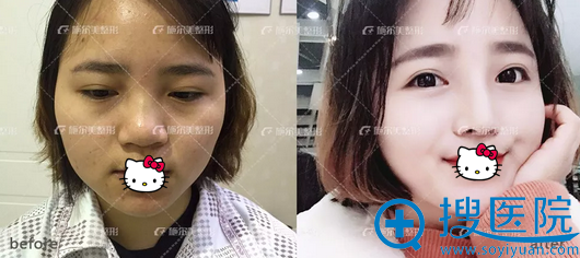 李彤彤鼻综合术前术后对比图片 李彤彤鼻综合术前术后对比图片