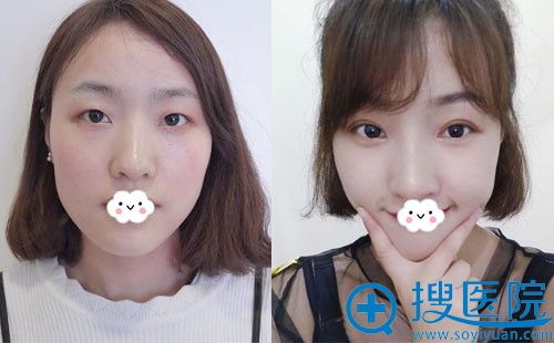 重庆军科整形医院陈宇双眼皮案例 重庆军科整形医院陈宇双眼皮案例