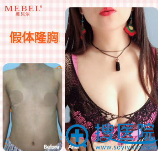 福州美贝尔假体隆胸真人案例效果图 福州美贝尔假体隆胸真人案例效果图