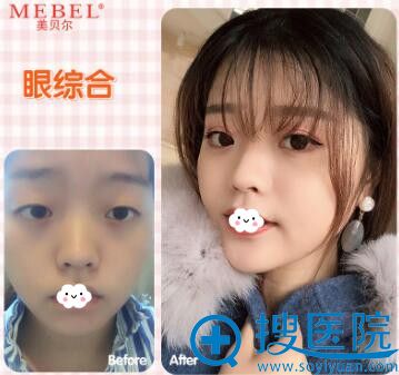 福州美贝尔割双眼皮真人案例效果怎么样? 福州美贝尔割双眼皮真人案例效果怎么样?