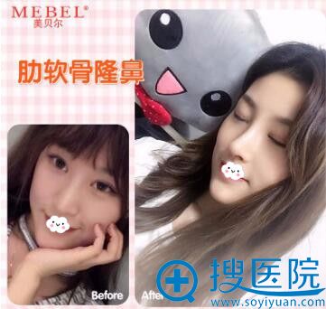 福州美贝尔隆鼻整形效果好吗? 福州美贝尔隆鼻整形效果好吗?