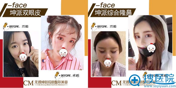 无锡坤如玛丽整形双眼皮和隆鼻案例 无锡坤如玛丽整形双眼皮和隆鼻案例