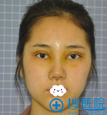 怀化天姿范章武双眼皮和隆鼻整形术后7天效果 怀化天姿范章武双眼皮和隆鼻整形术后7天效果