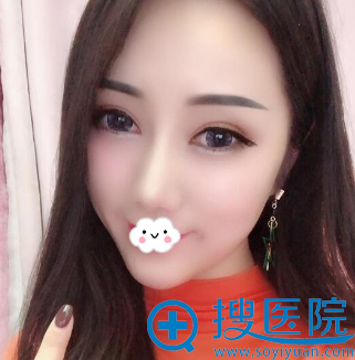 怀化天姿范章武双眼皮隆鼻下巴整形案例 怀化天姿范章武双眼皮隆鼻下巴整形案例