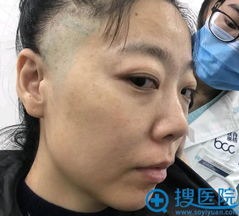 妈妈找杨大平做高位SMAS提升效果明显,我做的小切口MACS除皱
