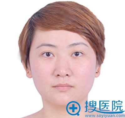 4年前做失败的双眼皮照片 4年前做失败的双眼皮照片