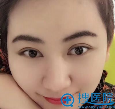 做完双眼皮修复30天恢复照 做完双眼皮修复30天恢复照