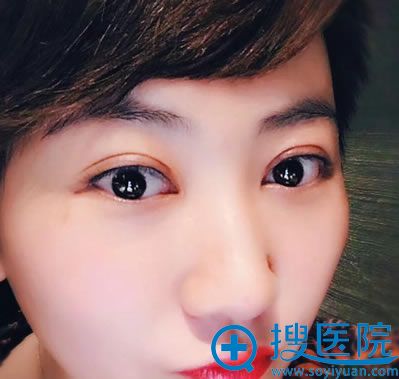 北京联合丽格刑新双眼皮修复案例 北京联合丽格刑新双眼皮修复案例