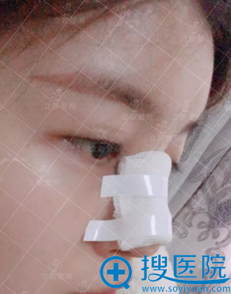 <!--<i data=20240710 data-id=12456></i>-->隆鼻术后第2天照片 <!--<i data=20240710 data-id=12456></i>-->隆鼻术后第2天照片
