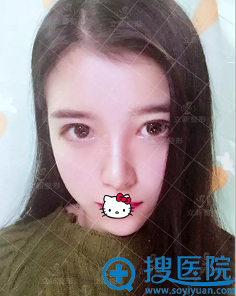 假体隆鼻术后15天恢复情况 假体隆鼻术后15天恢复情况