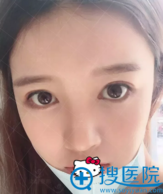 在<!--<i data=20240710 data-id=12456></i>-->做的隆鼻已经一个月了 在<!--<i data=20240710 data-id=12456></i>-->做的隆鼻已经一个月了