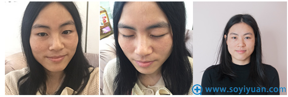 上海美莱何祥龙做双眼皮怎么样?无痕双眼皮真人案例和价格表