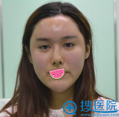 沈阳蓝天自体脂肪填充面部术后即刻效果 沈阳蓝天自体脂肪填充面部术后即刻效果