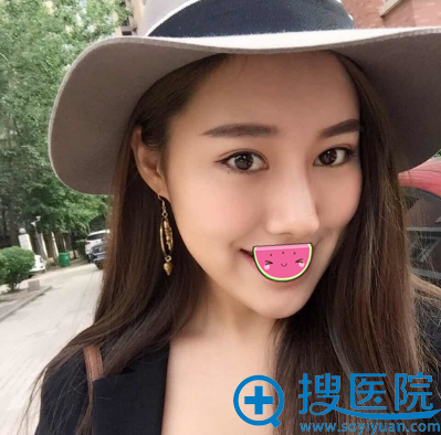 黄瑞兴自体脂肪填充全脸8个月效果 黄瑞兴自体脂肪填充全脸8个月效果