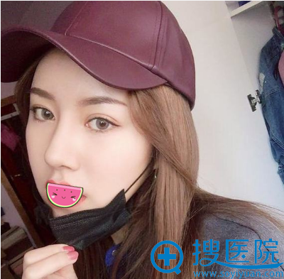 黄瑞兴面部二次脂肪填充3个月效果 黄瑞兴面部二次脂肪填充3个月效果