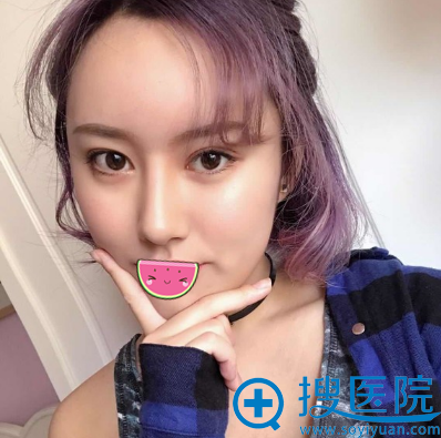 沈阳蓝天黄瑞兴二次脂肪填充全脸术后一年效果 沈阳蓝天黄瑞兴二次脂肪填充全脸术后一年效果