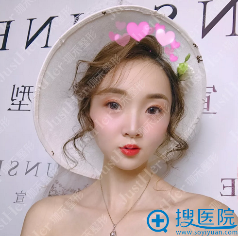 <!--<i data=20240710 data-id=10239></i>--><!--<i data=20240710 data-id=15869></i>-->做的线雕和玻尿酸隆鼻案例 <!--<i data=20240710 data-id=10239></i>--><!--<i data=20240710 data-id=15869></i>-->做的线雕和玻尿酸隆鼻案例