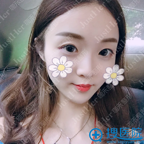 <!--<i data=20240710 data-id=13548></i>-->医院<!--<i data=20240710 data-id=15869></i>-->隆鼻案例 <!--<i data=20240710 data-id=13548></i>-->医院<!--<i data=20240710 data-id=15869></i>-->隆鼻案例