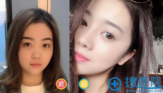 荆州华美医院李杰鼻综合案例 荆州华美医院李杰鼻综合案例