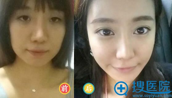 荆州华美医院李杰做双眼皮案例 荆州华美医院李杰做双眼皮案例