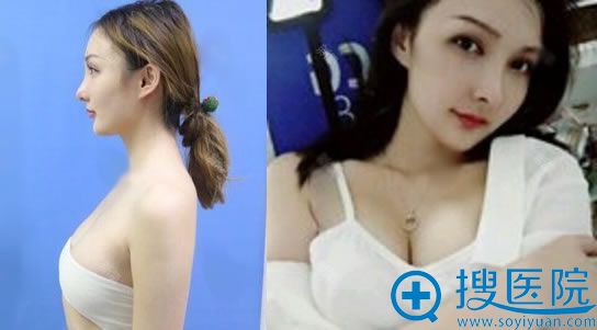北京卓颜蕊丽赵英利自体脂肪隆胸案例 北京卓颜蕊丽赵英利自体脂肪隆胸案例