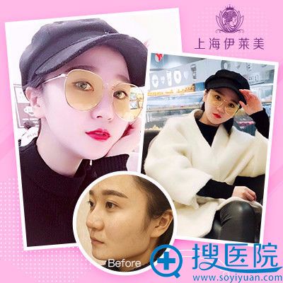 上海伊莱美李湘原做的下颌角整形案例 上海伊莱美李湘原做的下颌角整形案例