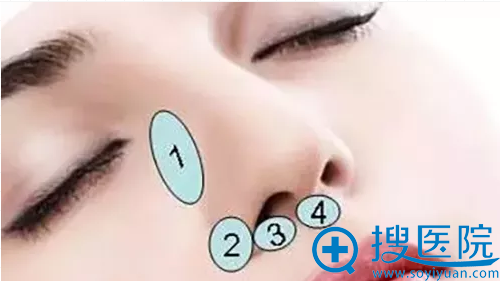 做隆鼻,医生为什么建议垫鼻基底?填充鼻基底用什么材料?