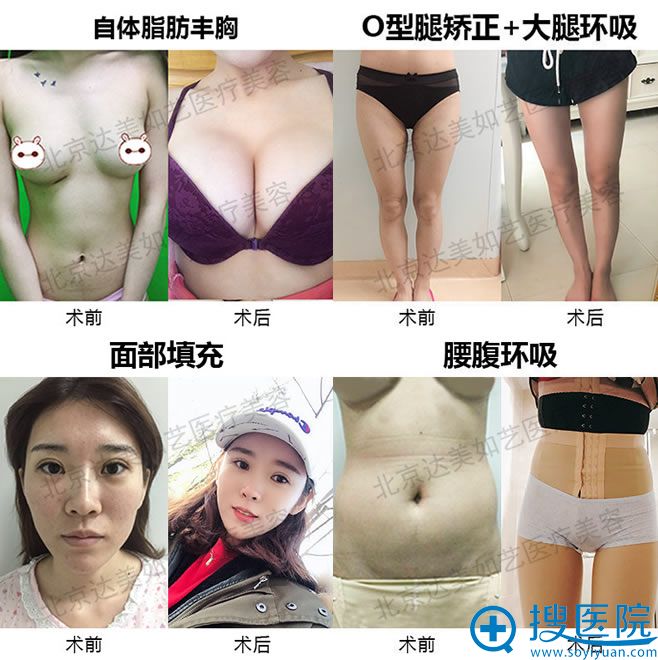 北京达美如艺吸脂和脂肪填充隆胸案例 北京达美如艺吸脂和脂肪填充隆胸案例