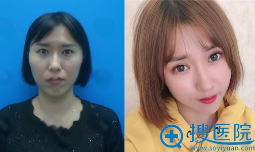 <!--<i data=20240710 data-id=13102></i>-->周杰做双眼皮案例 <!--<i data=20240710 data-id=13102></i>-->周杰做双眼皮案例