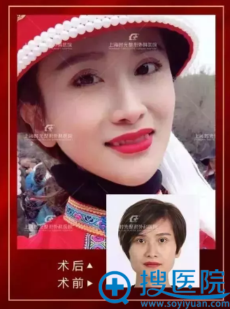 上海时光何晋龙做的下颌角整形案例 上海时光何晋龙做的下颌角整形案例